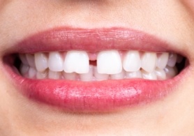 Close up of smile with gap between two front teeth