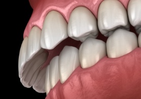 Illustrated mouth with overbite