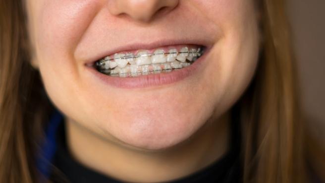 CLose up of person smiling with traditional orthodontics in Irving
