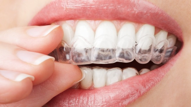 Close up of person placing Invisalign clear aligner over their teeth