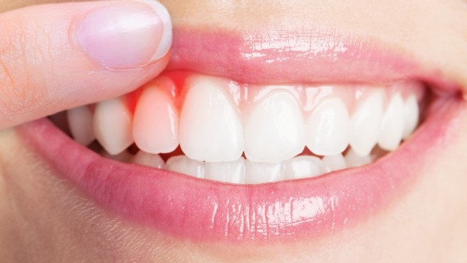 Close up of person pointing to red spot on their gums