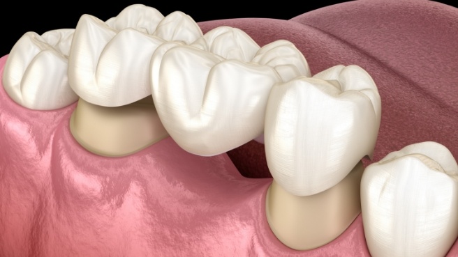 Illustrated dental bridge replacing a missing tooth in Irving
