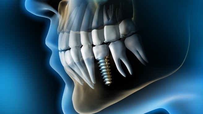 Illustrated X ray of person with dental implant replacing a missing tooth