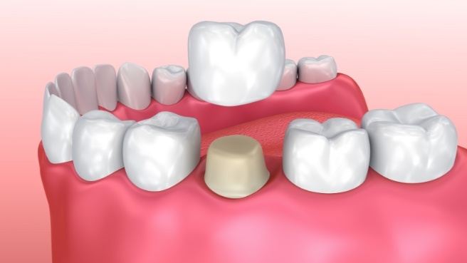 Illustrated dental crown being placed over a tooth