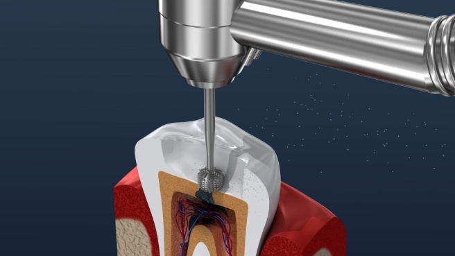 Illustrated dental instrument cleaning inside of tooth during root canal treatment