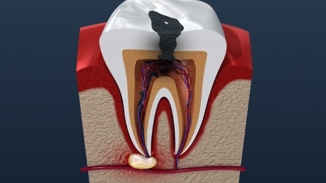Illustrated tooth with infection