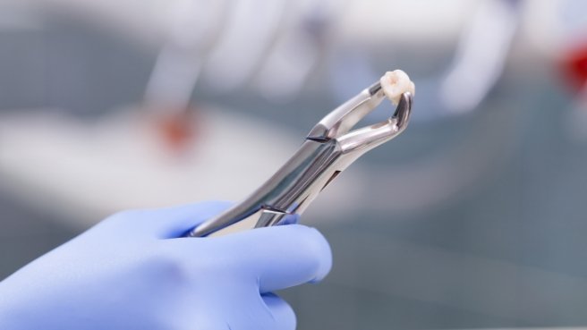 Dental forceps holding an extracted tooth