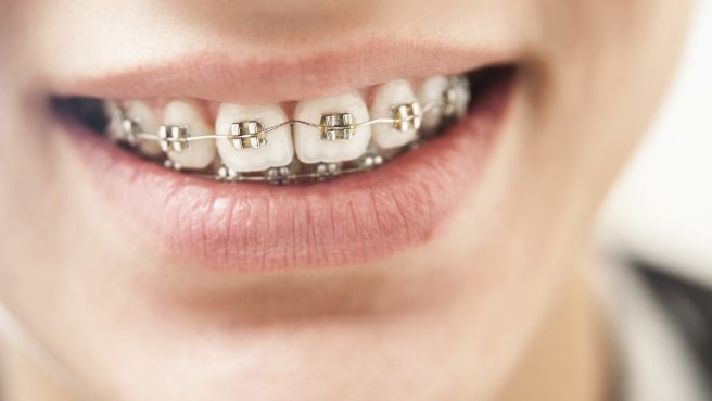 Close up of person smiling with traditional braces in Irving