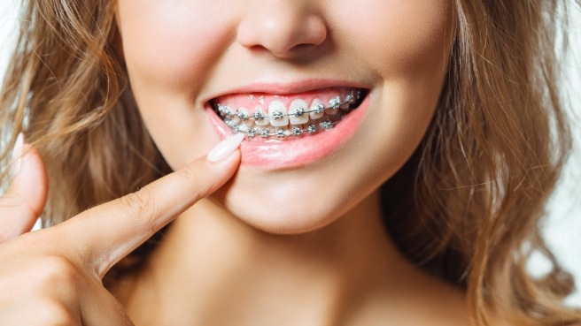 Young girl with braces pointing to her smile