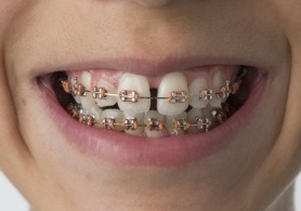 Close up of person with gap between two front teeth wearing braces
