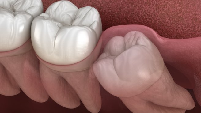 Illustrated impacted wisdom tooth pushing against other teeth