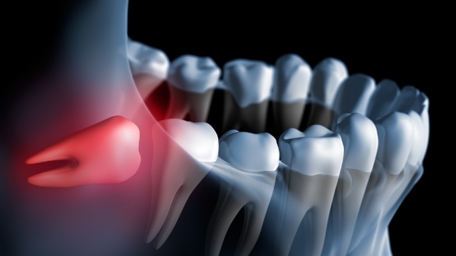 Illustrated impacted wisdom tooth highlighted red