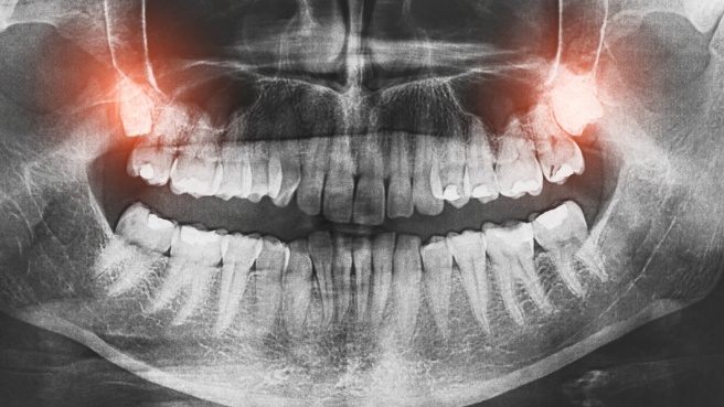 X ray of teeth with wisdom teeth highlighted red