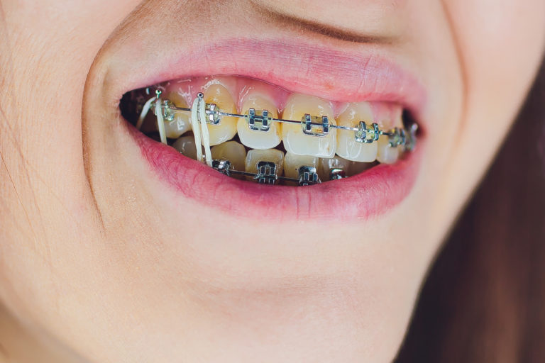 braces elastics orthodontic complicated