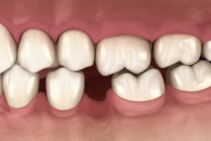 a computer illustration of teeth shifting