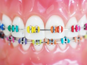 a model of a mouth with braces in Irving with colorful brackets