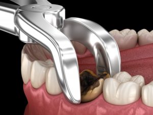 a computer illustration of a damaged tooth being removed