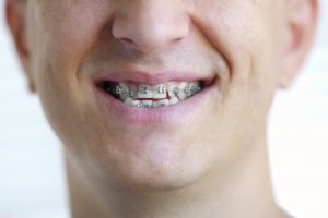 a person smiling and wearing braces