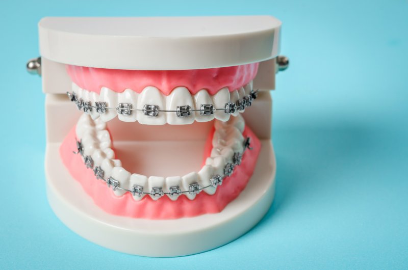 Tooth model with metal wire dental braces