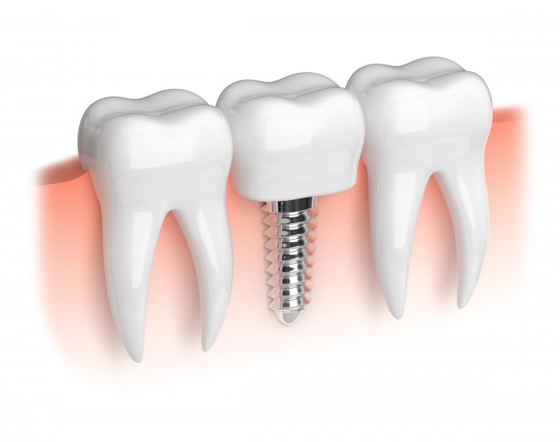 Close-up of a dental implant