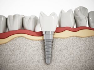 a graphic illustration of a dental implant