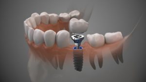 a digital rendering showing how dental implants work