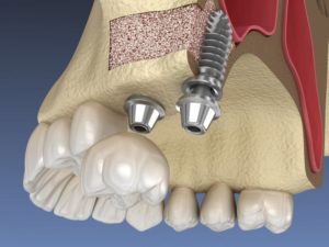 a graphic illustration of dental implants secured within the jawbone