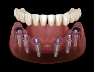 a digital image showing implant dentures