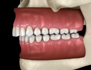 a computer model of a mouth depicting overbite