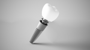 a stylized digital illustration of dental implant