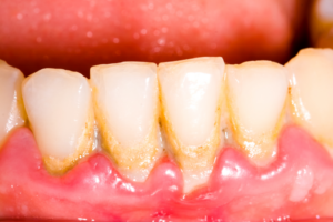 calculus build-up on a person's teeth